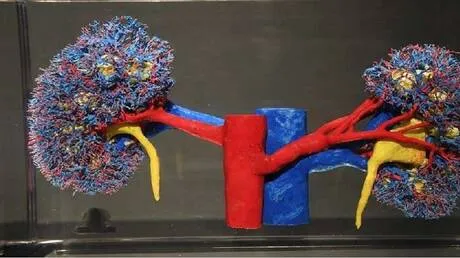 أطعمة تسبب حصى المسالك البولية