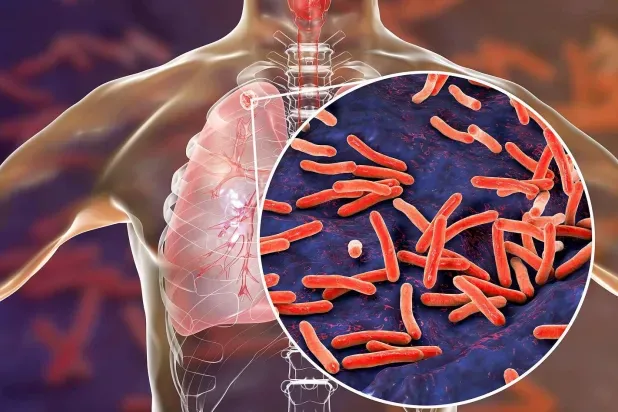طريقة مبتكرة لعلاج مرض السل