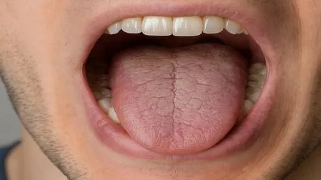 أسباب متلازمة "الفم الجاف"