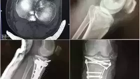 ‏ الأفلاج العام ينجح في تثبيت كسر مفتت لمصاب بحادث دهس
