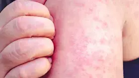 1001 حالة حصبة مؤكدة في أمريكا
